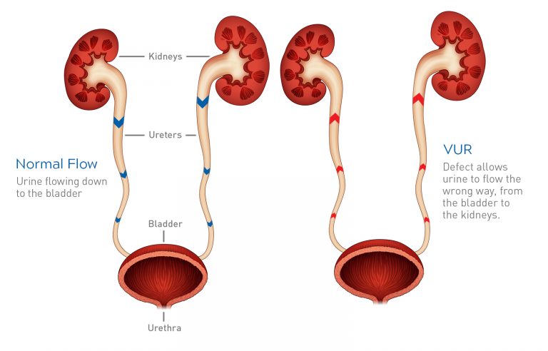 Vesicoureteral Kidney Reflux Information