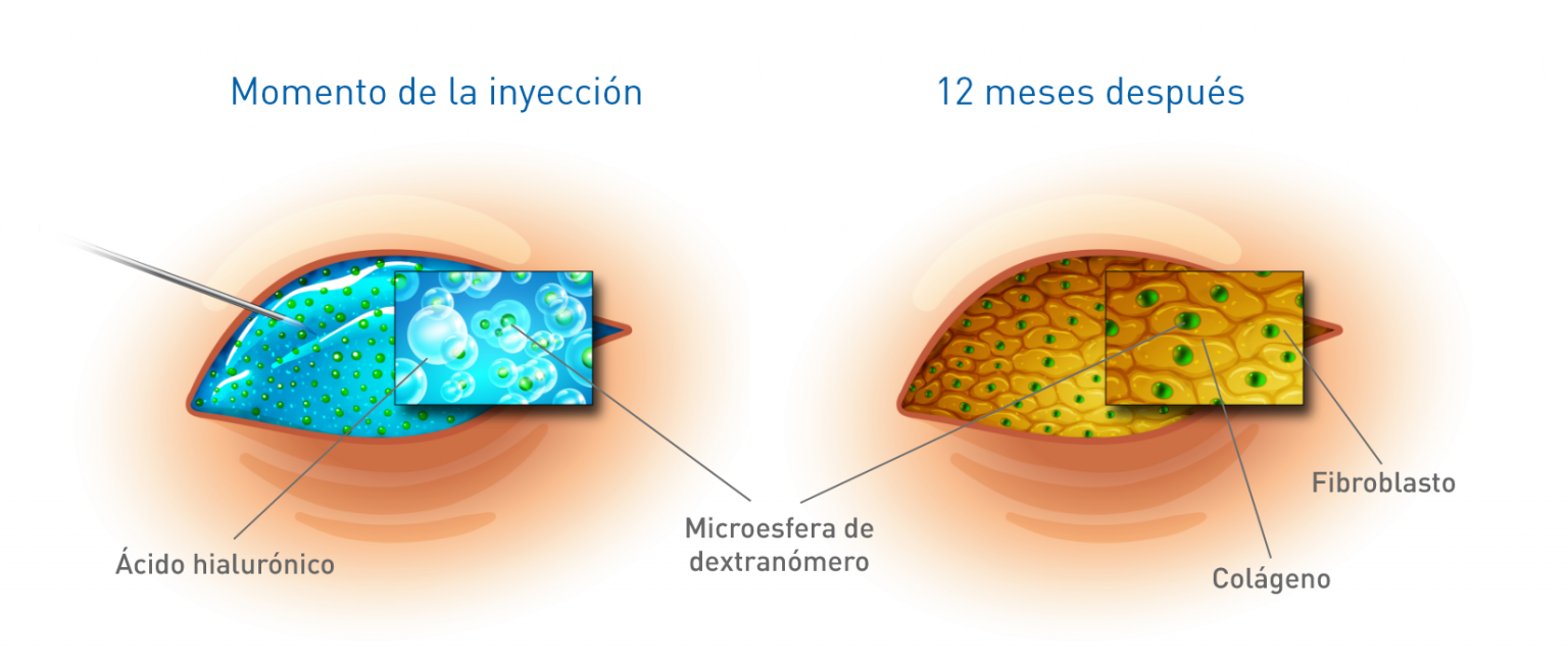 Materiales de Deflux NASHA y dextranómero